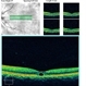 Tamoxifen Maculopathy Tamoxifen Maculopathy