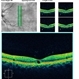 Tamoxifen Maculopathy Tamoxifen Maculopathy