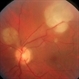 Cryptococcus Endogenous Endophthalmitis Cryptococcus Endogenous Endophthalmitis