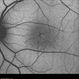 Type 1A Macular Telangiectasia - Autofluorescence Type 1A Macular Telangiectasia - Autofluorescence
