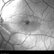 Type 1A Macular Telangiectasia Type 1A Macular Telangiectasia