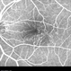 Type 1A Macular Telangiectasia - Fluorescein Angiogram - Early Type 1A Macular Telangiectasia - Fluorescein Angiogram - Early