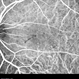 Type 1A Macular Telangiectasia - ICG Angiogram Type 1A Macular Telangiectasia - ICG Angiogram
