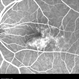 Type 1A Macular Telangiectasia - Fluorescein Angiogram - Late Type 1A Macular Telangiectasia - Fluorescein Angiogram - Late