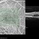 Type 1A Macular Telangiectasia - OCT Type 1A Macular Telangiectasia - OCT