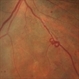 Venous Loop in Severe Nonproliferative Diabetic Retinopathy Venous Loop in Severe Nonproliferative Diabetic Retinopathy