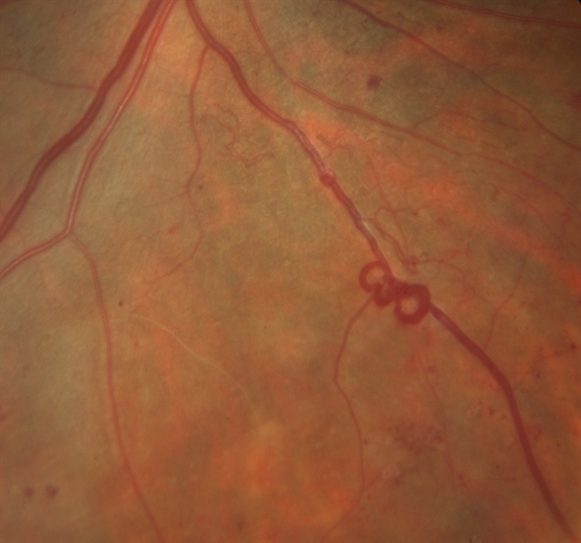 Venous Loop In Severe Nonproliferative Diabetic Retinopathy Retina Image Bank Venous Loop In Severe Nonproliferative Diabetic Retinopathy Retina Image Bank