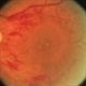 Serous Retinal Detachment Due to Systemic Hypertension (Pre-Eclampsia) Serous Retinal Detachment Due to Systemic Hypertension (Pre-Eclampsia)