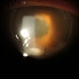 Endophthalmitis