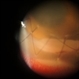 Endophthalmitis