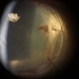 Endophthalmitis