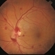 Posterior Vitreous Detachment Posterior Vitreous Detachment