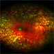 Diabetic Retinopathy Diabetic Retinopathy