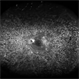 Diabetic Retinopathy Diabetic Retinopathy