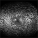 Diabetic Retinopathy Diabetic Retinopathy
