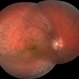 Diffuse Choroidal Hemangioma OD Diffuse Choroidal Hemangioma OD