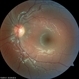 Diffuse Choroidal Hemangioma, Normal OS Eye Diffuse Choroidal Hemangioma, Normal OS Eye