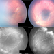 Aggressive Posterior Retinopathy of Prematurity (AP-ROP)