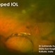 Dropped IOL Dropped IOL