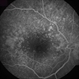 Dry Age-Related Macular Degeneration, Fluorescein Angiogram Dry Age-Related Macular Degeneration, Fluorescein Angiogram