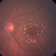 Calcified drusen, fundus photograph Calcified drusen, fundus photograph