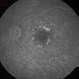 Calcified Drusen, Fluorescein Angiogram Calcified Drusen, Fluorescein Angiogram