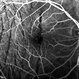 Fluorescein Angiography of Ocular Hypotony Fluorescein Angiography of Ocular Hypotony