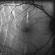 Autofluorescence of Ocular Hypotony Autofluorescence of Ocular Hypotony