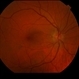 Choroidal Nevus Choroidal Nevus