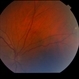 Choroidal Nevus Choroidal Nevus