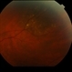 Choroidal Nevus Choroidal Nevus
