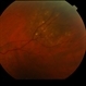 Choroidal Nevus Choroidal Nevus