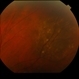 Choroidal Nevus Choroidal Nevus