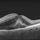 EDI-Optic Neuritis/Neuroretinitis EDI-Optic Neuritis/Neuroretinitis