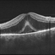 EDI-Optic Neuritis/Neuroretinitis EDI-Optic Neuritis/Neuroretinitis