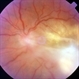 Endogenous Candida Endophthalmitis