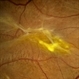 Epiretinal Membrane Epiretinal Membrane