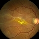 Epiretinal Membrane Epiretinal Membrane