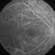 Diabetic Macular Edema - Leaking Microaneurysms Diabetic Macular Edema - Leaking Microaneurysms