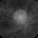Early Phase FA of Optic Disc Capillary Hemangioblastoma Early Phase FA of Optic Disc Capillary Hemangioblastoma