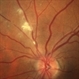 Retinal Artery Embolus Retinal Artery Embolus