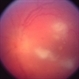 Candida Albicans Endophthalmitis