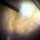 Endogenous Candida Endophthalmitis Endogenous Candida Endophthalmitis