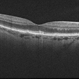 Evolution of VMT - OCT 4 at 12 months Evolution of VMT - OCT 4 at 12 months