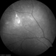 Extra Macular CNV with Spontaneous Resolution Extra Macular CNV with Spontaneous Resolution