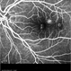 Polypoidal Choroidal Vasculopathy-FA