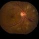Diabetic Macular Edema Diabetic Macular Edema