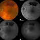 Retinal Arterial Macroaneurysm Retinal Arterial Macroaneurysm