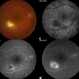 Toxoplasmosis Toxoplasmosis