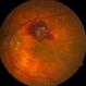 Retinal Arterial Macroaneurysm s/p Laser Treatment Retinal Arterial Macroaneurysm s/p Laser Treatment
